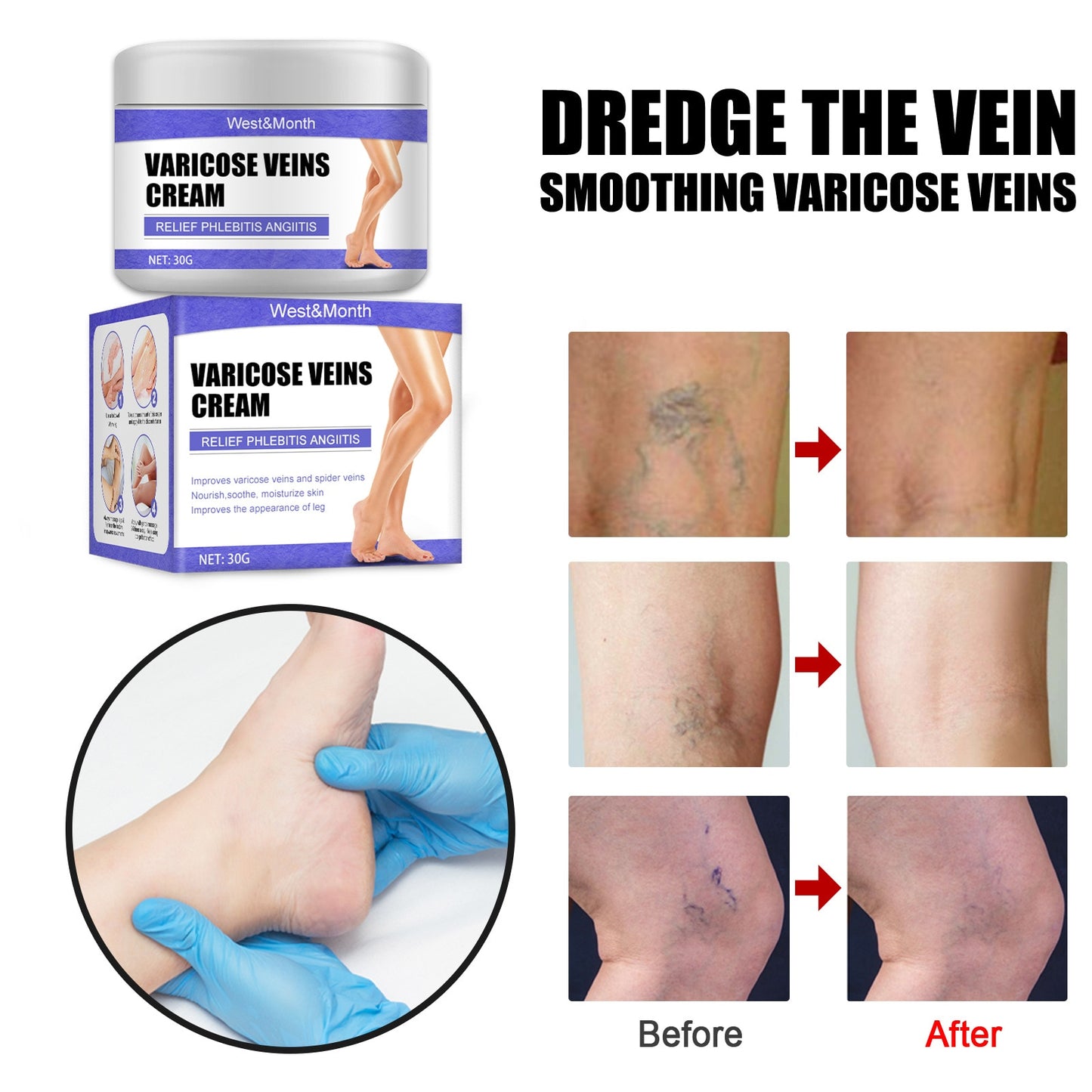 Effective Varicose Veins Feet Cream Relieve Vasculitis Phlebitis Spider Pain Treatment Ointment Medical Plaster Body Foot Care