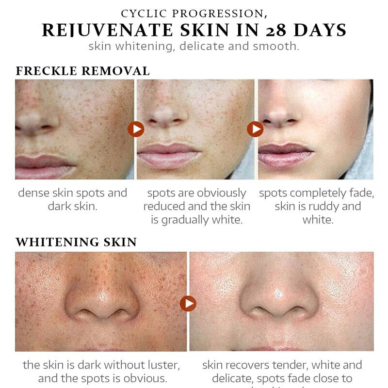 Whitening Face Cream for Removal Freckles and Dark Spots Skin Repair Whitening and Moisturizing Remove Sunburn Whitening Cream