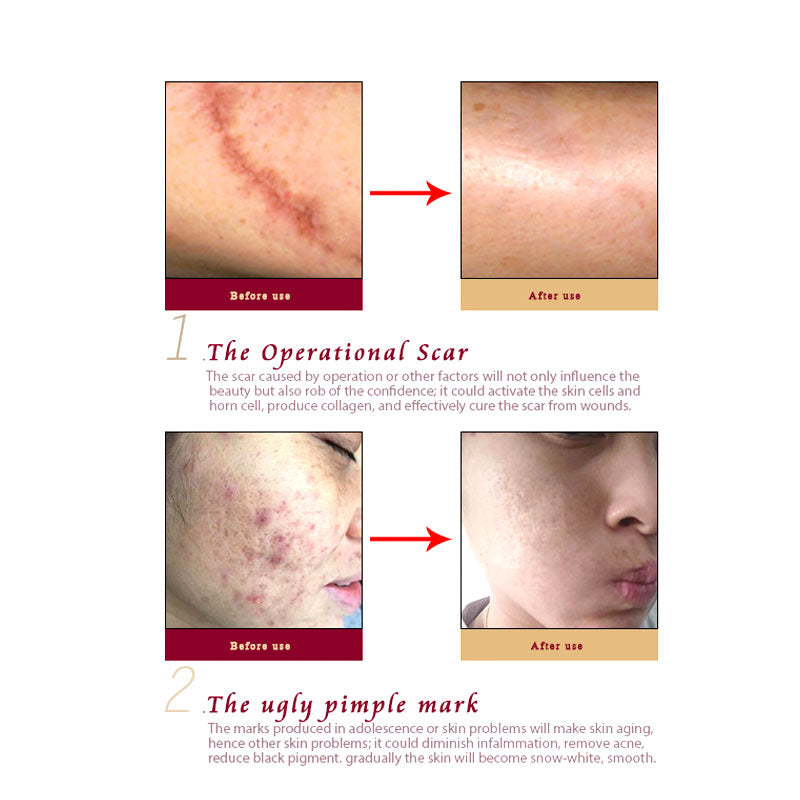 ARTISCARE ginseng extract against black dots cream scar removal facial blackhead acne skin care treatment bleaching cream 30ml