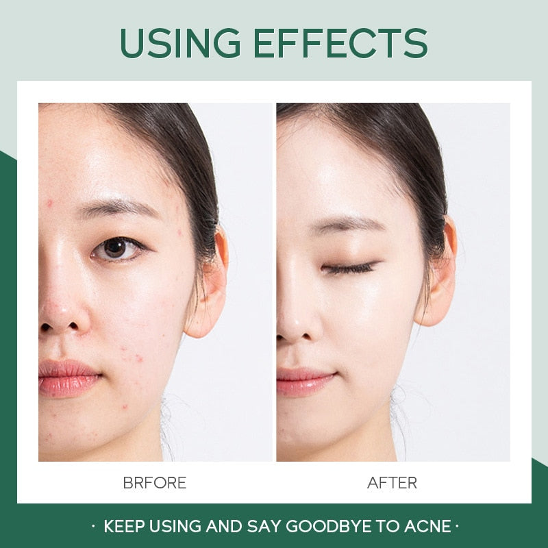 LAIKOU Tea Tree Acne Cream Anti-Acne Oil Control Repair Fade Acne Spots Shrink Pores Whitening Moisturizing Face Gel Skin Care