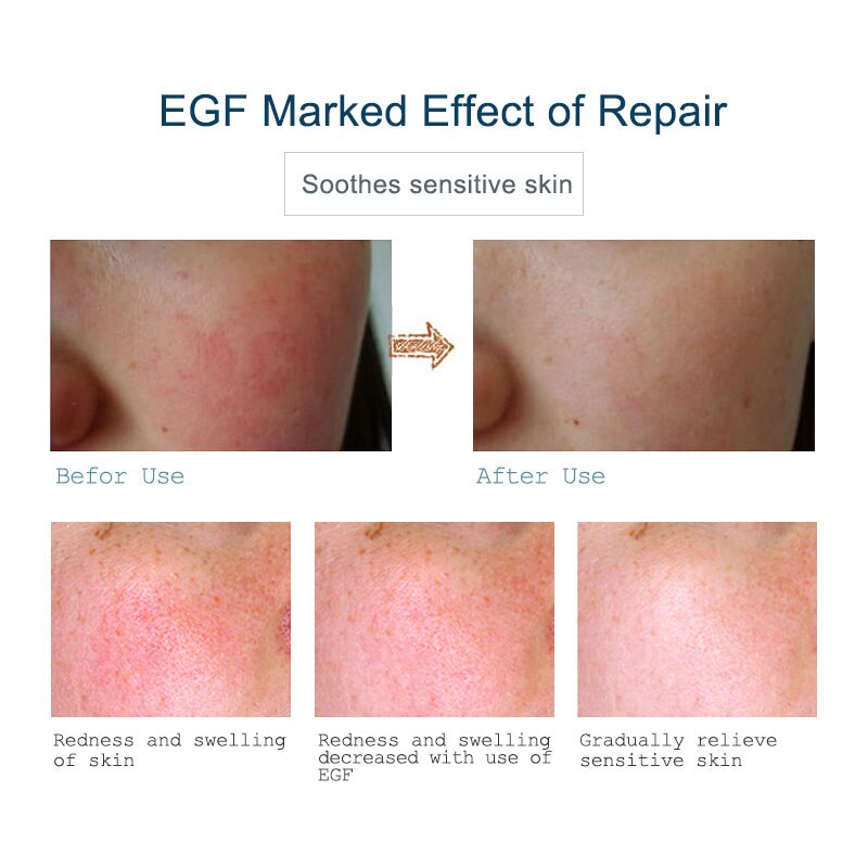 ARTISCARE EGF Repair Serum 2pcs Acne Treatment &amp; Blackhead Removal Skin Care Anti Aging Anti Wrinkle Whitening for Face Essence