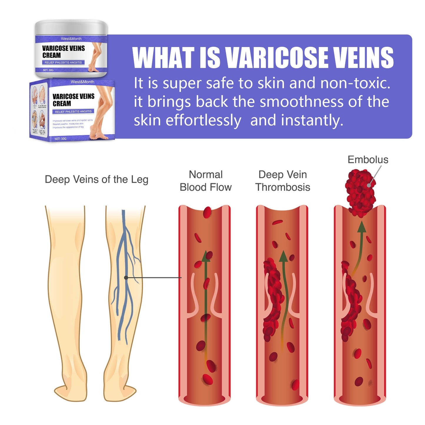 Effective Varicose Veins Feet Cream Relieve Vasculitis Phlebitis Spider Pain Treatment Ointment Medical Plaster Body Foot Care