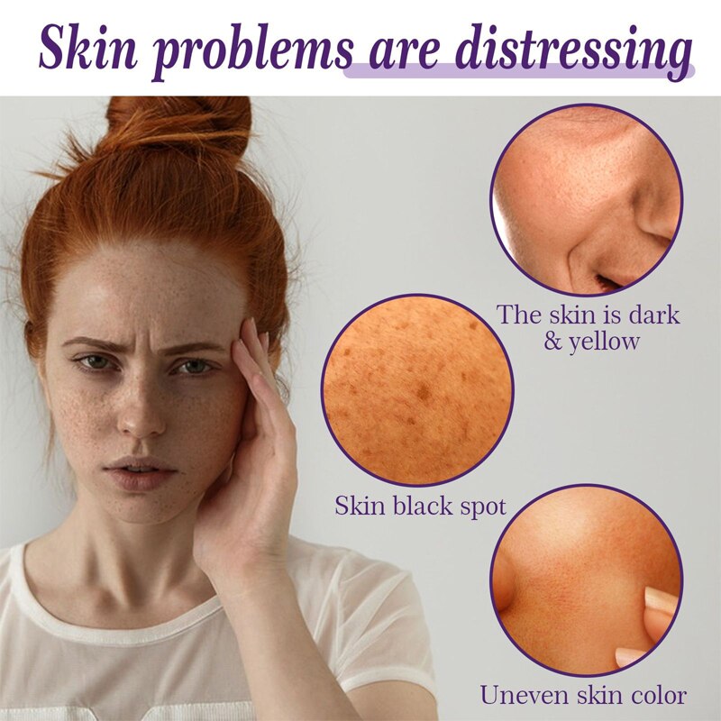 Vitamin C Whitening Freckle Face Serum Remove Melasma Acne Dark Spots Pigmentation Brighten Moisturizing Nourish Skin Care 30ml
