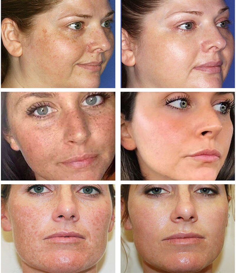 Vitamin C Whitening Freckle Serum Remove Melasma Acne Dark Spots Fade Pigment Melanin Corrector Moisturizing Brighten Skin Care