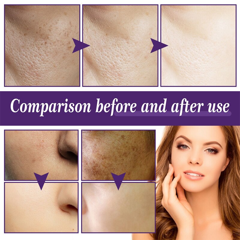 Vitamin C Whitening Freckle Face Serum Remove Melasma Acne Dark Spots Pigmentation Brighten Moisturizing Nourish Skin Care 30ml