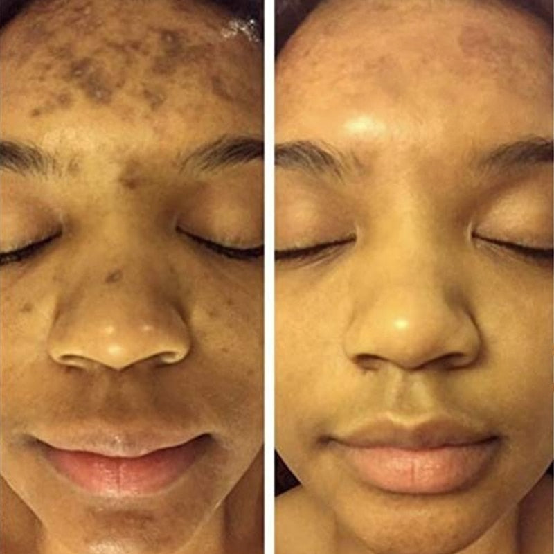 Turmeric Serum Whitening Freckle Dark Spots Organic Turmeric Oil Brighten Dark Skin Pigmentation Anti Aging Anti Wrinkle Essence