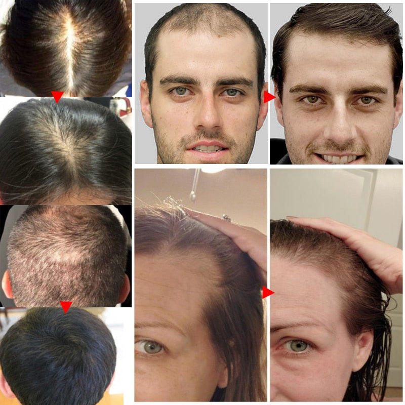 Fast Hair Growth Spray Products Anti Hair Loss Serum Prevent Baldness Treatment Scalp Dry Damaged Beard Hair Care Essential Oils