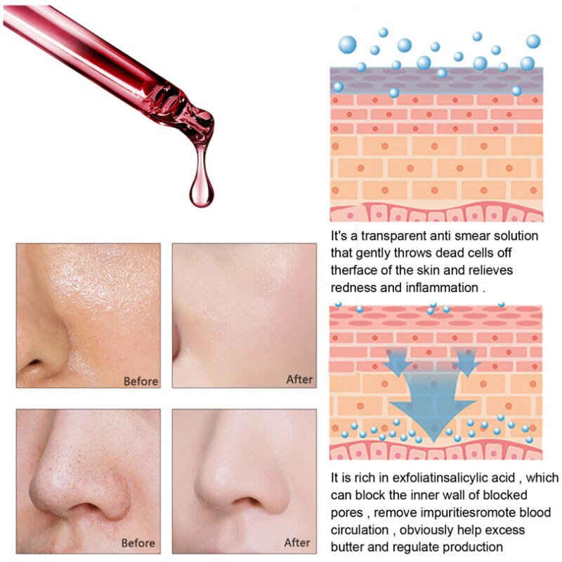Shrink Pores Serum Salicylic Fruit Acid Essence Exfoliating Moisturizing Nourish Smooth Pore Repair Dry Skin Care Cosmetic 30ml